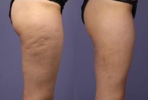 cellulite removal transformation 